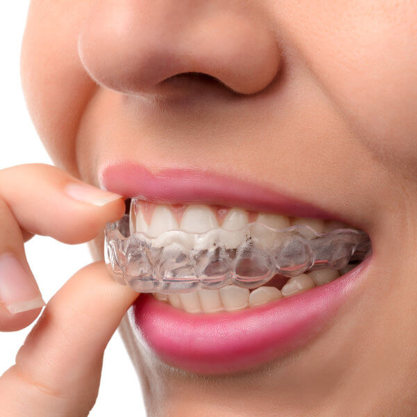 Wybielanie zebów Tczew - metoda wybielania zębów DENTU white to usługa z zakresu stomatologii estetycznej.