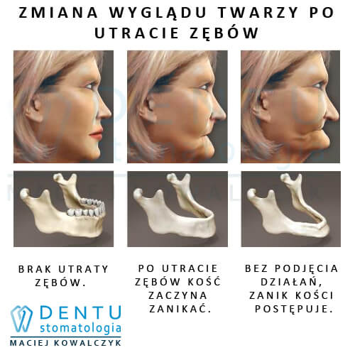 Periodontolog Tczew - leczenie paradontozy - twarz po utracie zębów
