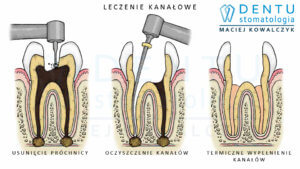 Leczenie kanałowe Tczew - stomatologia mikroskopowa