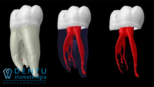 mikroskopowe leczenie zębów - stomatologia mikroskopowa Tczew - anatomia korzeni zęba
