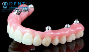 Proteza na implantach, implanty Tczew, implanty stomatologiczne, dentu, dentysta tczew