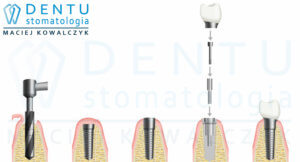 implanty stomatologiczne, implanty zębów tczew, maciej kowalczyk, dentu stomatologia