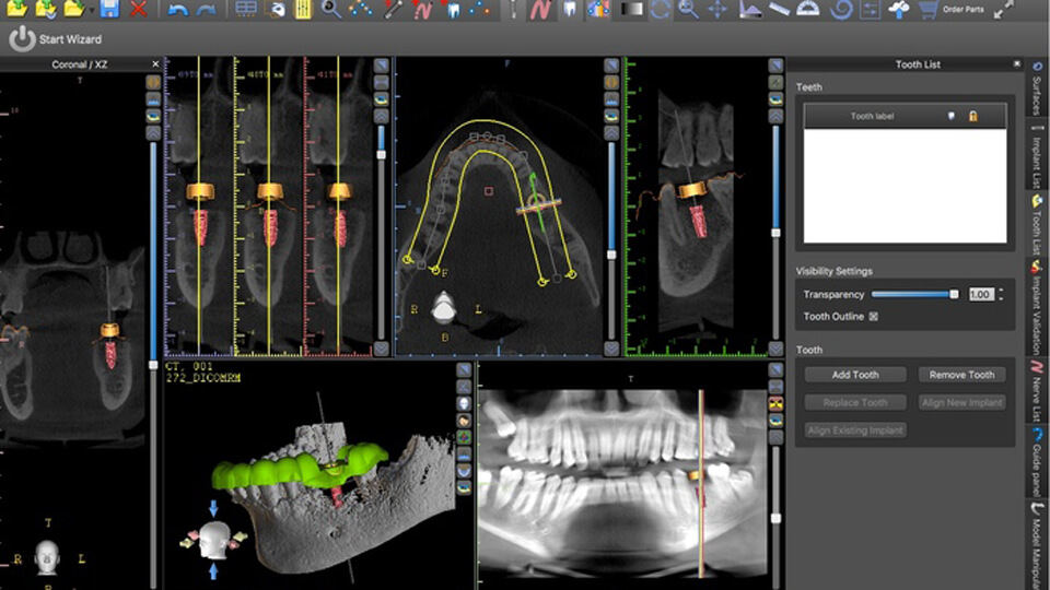 Implanty zębów Tczew - nawigacja komputerowa 3D
