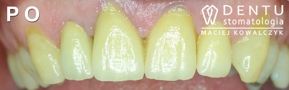przed i po zęby - metamorfoza uśmiechu