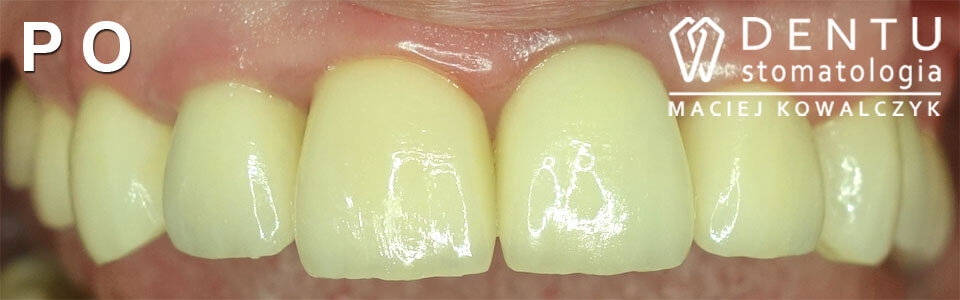 przed i po zęby- metamorfoza uśmiechu