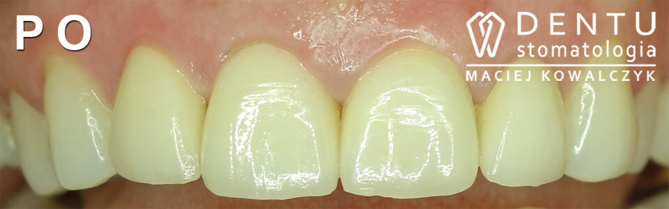 przed i po zęby
