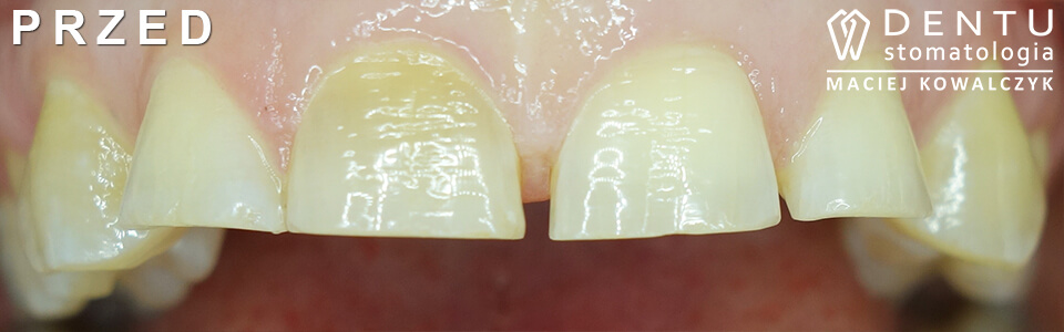 bruksizm - leczenie zgrzytania zębami