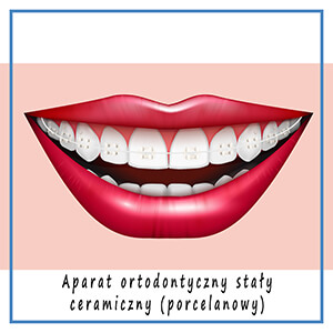 ortodoncja tczew - aparat ortodontyczny stały