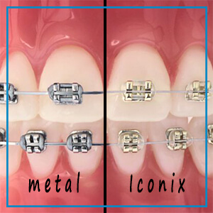ortodoncja tczew - aparat ortodontyczny stały